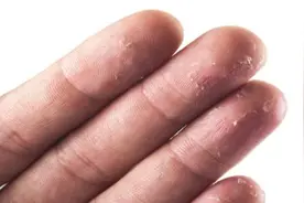 你为什么手掌脱皮？原来是这6个原因！图片