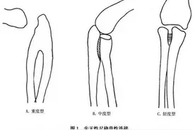 先天性尺桡骨融合图片