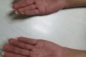 叛逆？爱美？15岁少年总爱留长指甲，原来跟这种病有关图片