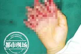 疼！妈妈一时疏忽，2岁男童手掌被绞肉机打成了“面条指”图片