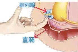 前列腺是否增生？这些症状和要点您了解吗？图片