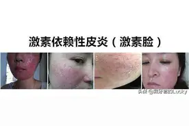 怎样回应成激素脸？激素脸如何预防以及修复？图片