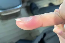 TVB女星拔倒刺上了手术台！手贱一时爽，拔完火葬场图片