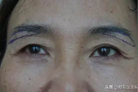 关于"提眉手术"，通过这21个问题，老祝与您说说真心话图片