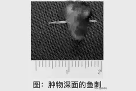 阿姨舌头肿胀险致癌！“罪魁祸首”竟是餐桌上常见的TA…图片