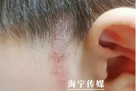 6岁男孩脸部皮肤溃烂，只因碰了这个小东西！遇到千万别打图片