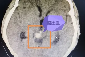 青海37岁女患者突发脑出血，浙江医生千里驰援，不开颅“一根针”治好脑部血管畸形团图片