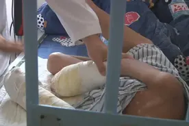 揪心！男童疑遭生父虐待！满身烟头烫伤疤痕或截肢图片