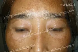 黄褐斑到底如何治疗呢？图片