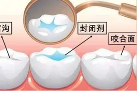 幼童牙齿涂氟真的能预防龋齿吗？会对身体有害吗？听听牙医的说法图片