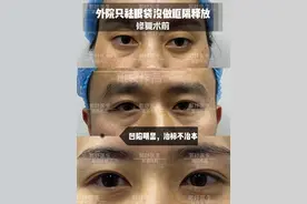 想去眼袋，不做眶隔释放可以吗？图片