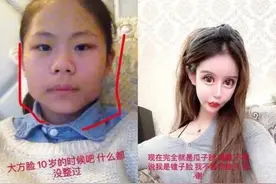 13岁女孩“沉迷整容”，3年整了60多次，如今的五官令人一言难尽图片