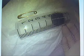 惊！长春男婴吞下开口别针  医生在胃中闭合别针，惊险取出！图片