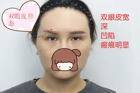 南阳女士割双眼皮失败了，今天给她修复过程很辛苦，结果很满意图片
