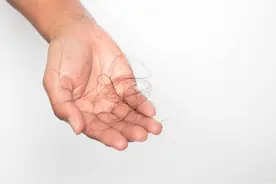 脱发人士必看：拯救发量的N个办法，到底哪个最靠谱？图片