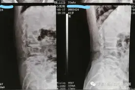 83岁高龄老人的两次脊柱微创手术图片