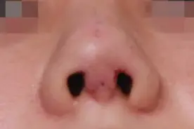 为什么部分鼻整形术后鼻子更大了？图片