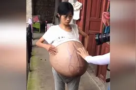 女子患多种疾病肚子长成40斤巨球 只能坐着睡觉视频封面