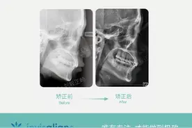 厦门牙齿矫正：「隐适美矫正-内倾型深覆合案例」图片