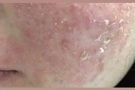 如何修复激素脸图片