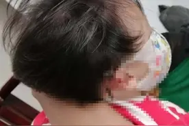 7厘米长的螺丝刀插入2岁女孩脑部，只因一个小疏忽图片