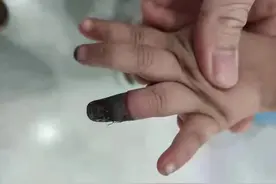痛心！家人错误包扎，3岁女童手指被截肢，协和专家提醒：创口贴使用也有大学问图片