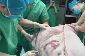 最良心医院！河南小伙全身96%烧伤，医生用猪皮做手术，节省19万8图片