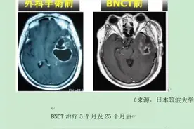 硼中子俘获治疗BNCT图片