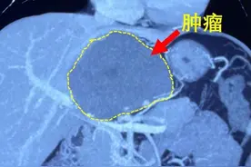哈医大一院肝胆专家熟练应用微创技术 “拆除”肝尾状叶肿瘤图片