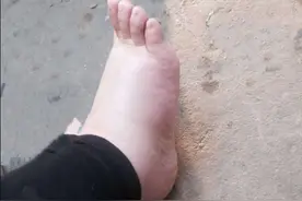 为什么一到夏季腿和脚就容易肿胀？图片