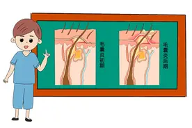 头皮上经常长小疙瘩，一碰就疼，对身体有什么影响吗？告诉你答案图片