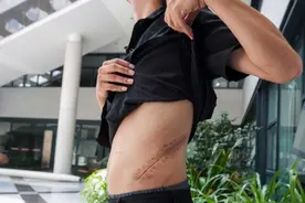 9年前卖肾买手机的小伙，如今五级伤残！人切除一个肾，危害不小图片