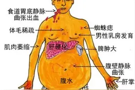肝硬化都有哪些类型？肝硬化其实是一种常见的慢性肝病图片