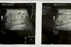 乳腺彩超报告，没有这几点就不必过于忧心图片