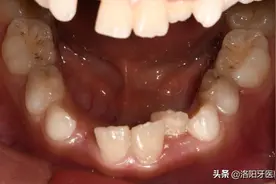 老人常说：矫正须等12岁后换完牙做！你认为这样的说法对吗？图片