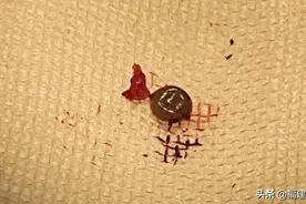 福州女子眼角长了个“肉球”，一查竟是活虫！这种虫严重可致死图片