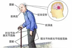 腰痛老治不好，“元凶”可能是帕金森病图片