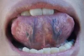 舌头下出现青筋，可能是血管有淤血的表现，看看自己有吗？图片