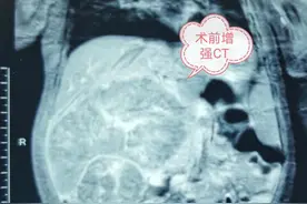 哈尔滨市儿童医院普外二科张浩然主任多学科团队作战摘除“巨瘤”图片