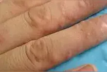 警惕！身上出现这种小水泡，千万别挠！现在看还不晚图片