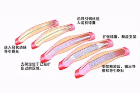 冠心病支架术后如何做“保养”？心内科专家的答案来了图片