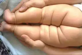 臀纹不对称值得担心吗？图片