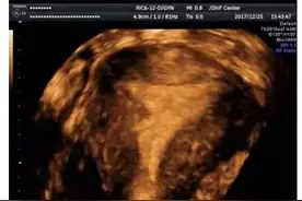 三维超声对宫腔粘连评估的重要性图片
