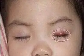 儿子眼睛上长了个小包，妈妈以为过几天就好了，带去检查后，泪目图片