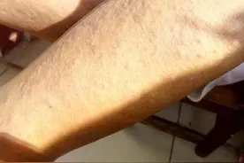 天热啦，起痱子的人多啦，下面说说痱子的病因及治疗方法。图片