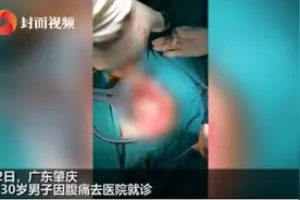 男子体内发现非洲鲫鱼：我不小心坐到鱼上了，鱼才从肛门进去的图片