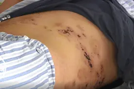 怎么回事？男子只是熬了几天夜，左腿突然长出大量水泡！图片