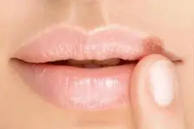 嘴唇长泡因上火？得了口唇疱疹还蒙在鼓里图片