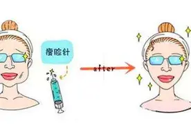 瘦脸针你该这样打！协和医生注射体验大分享图片