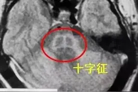 橄榄脑桥小脑萎缩的诊断要点（十字征）图片